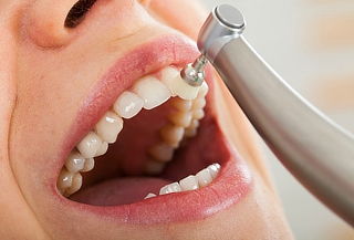 Limpieza dental profesional con ultrasonido + Profilaxis 