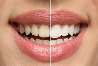 2 Sesiones de blanqueamiento dental + Limpieza profunda