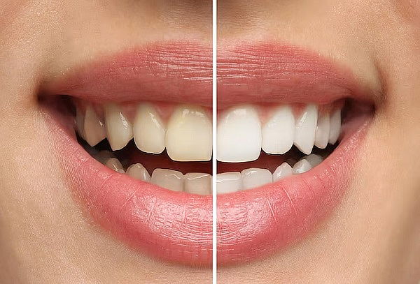 2 Sesiones de blanqueamiento dental + Limpieza profunda