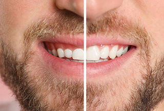 Valoración + Gingivoplastia o Diseño de Encías 