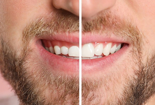 Valoración + Gingivoplastia o Diseño de Encías 