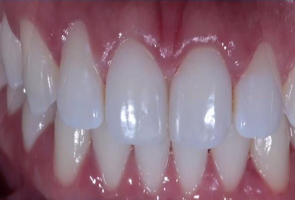 Diseño de sonrisa: 6 dientes superiores (de canino a canino)