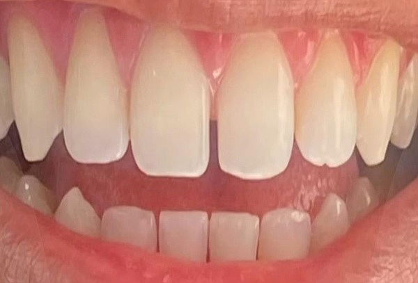 Diseño de sonrisa: 6 dientes superiores (de canino a canino)