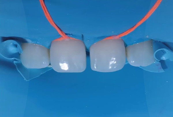 Diseño de sonrisa: 6 dientes superiores (de canino a canino)