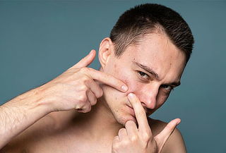 20 Sesiones de Tratamiento de Acné y Manchas en Galerías