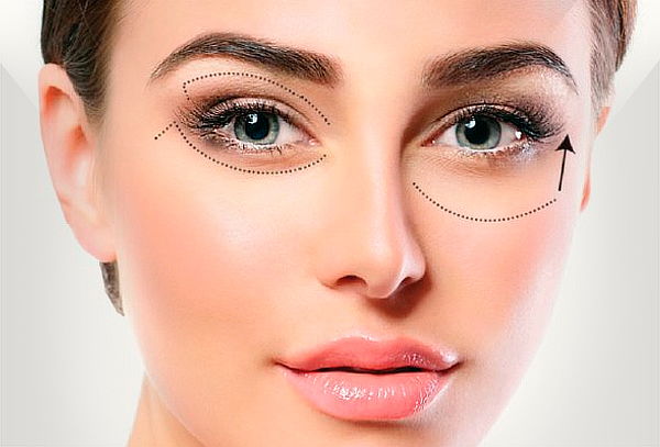 Blefaroplastia en Párpados NO Quirúrgica con Fibroblast