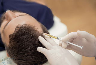 5 Sesiones de plasma rico en plaquetas capilar 