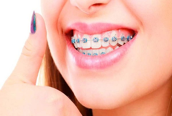 Valoración + Montaje de Brackets Mini Roth + Limpieza Dental