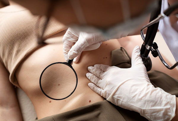 Tratamiento para Remover Lunares o Verrugas – Máximo 10