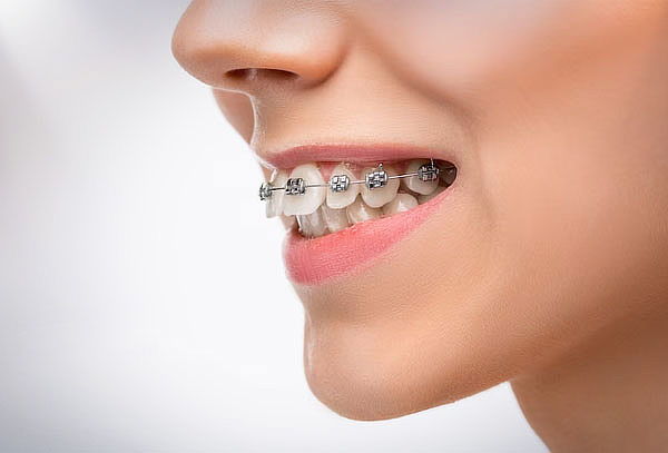 Brackets MBT, Montaje Superior y Inferior en Puentelargo 