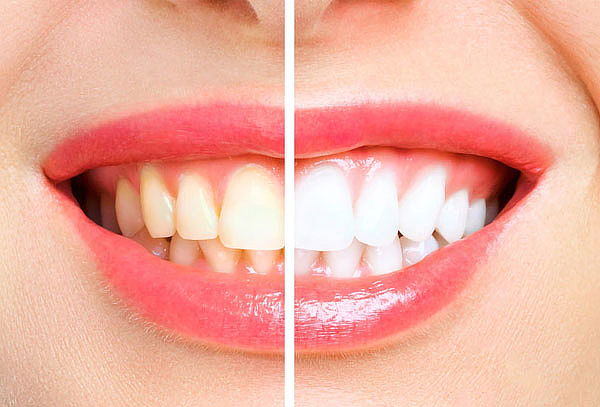 Microdiseño de Sonrisa Bordes Resina alta Estética 6 dientes