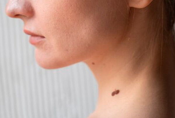 Remoción de 1 o 2 Lunares o Verrugas con Láser Hasta 5 mm