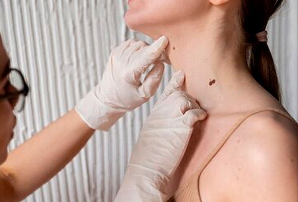 Remoción de 1 o 2 Lunares o Verrugas con Láser Hasta 5 mm