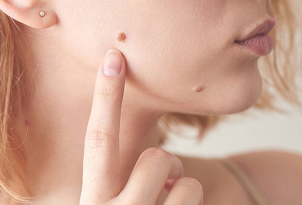 Remoción de 5 Lunares o Verrugas en Plaza de las Américas 