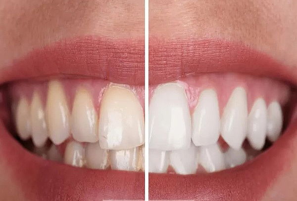 2 Sesiones Blanqueamiento Dental Láser + Profilaxis + Fluor