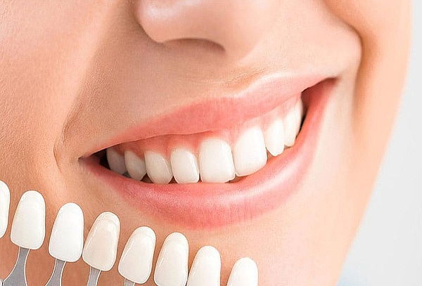 2 Sesiones Blanqueamiento Dental Láser + Profilaxis + Fluor