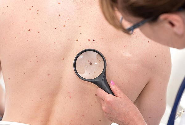 Eliminación de Lunares o Verrugas con Cauterizador San Diego