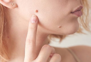 Remoción de 5 Lunares o Verrugas en Plaza de las Américas 