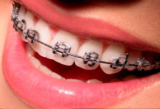 Brackets MBT Superior e Inferior + Valoración + Profilaxis