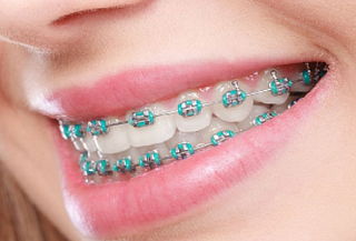 Brackets Metalicos + Valoración + Profilaxis + Fotografías