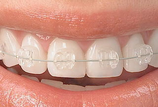 Brackets Estéticos + Valoración + Profilaxis + Fotografias