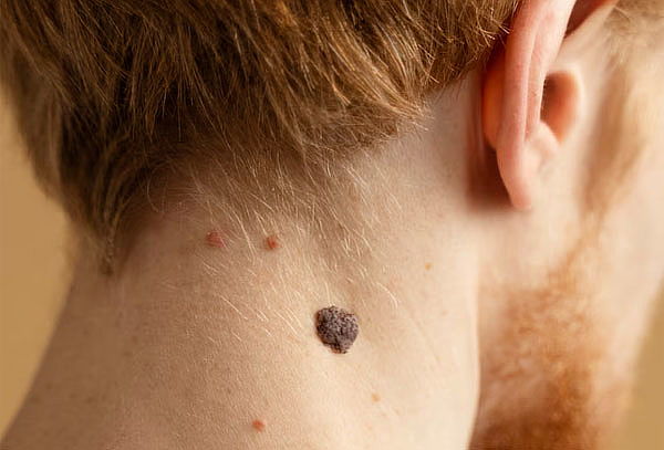 Retiro de 7 Verrugas o Lunares Laser CO2 en  Salitre Plaza