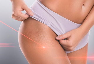 Desvanece y Mejora la Apariencia de las Estrías 