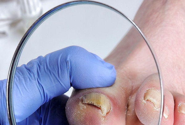 Tratamiento para Onicomicosis + Aplicación de ácido