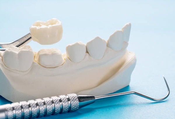 Corona Dental En Zirconio + Valoración 