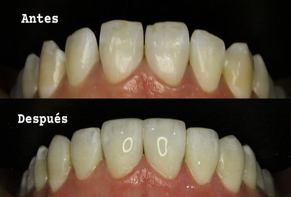 Microdiseño de Sonrisa (6 Bordes Dentales en Resina)