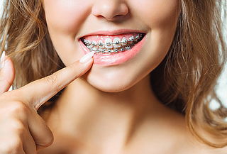 Brackets Roth + Limpieza en Puentelargo