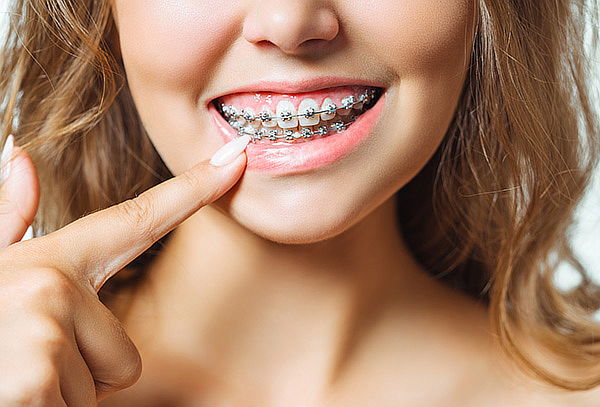 Brackets Roth + Limpieza en Puentelargo