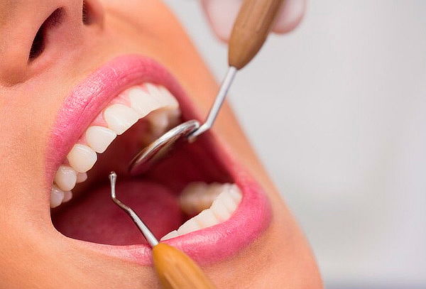 Limpieza Dental Profunda + Profilaxis + Detartraje