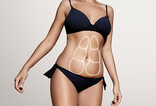 Reducción Zona Localizada con criolipólisis en Chicó