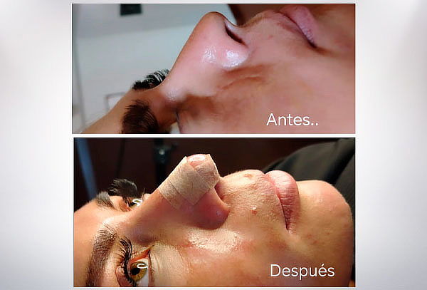 Rinomodelación de Nariz con Ácido Hialurónico de Implante