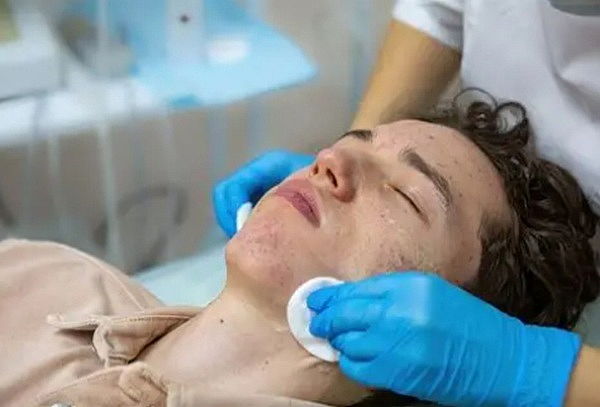 Protocolo Anti-Acné 6 Sesiones + Control Facial + Detox