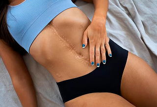 Láser CO2 Fraccionado para Cicatrices en Salitre Plaza