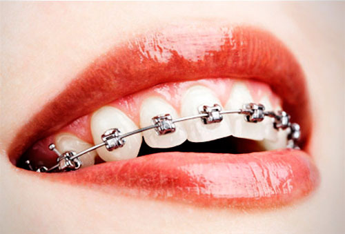 ¡Brackets Mini: Dientes Perfectos por sólo $299! ¡Regálale una sonrisa perfecta a tu boca, alinea tus dientes y sonríele a la vida!
