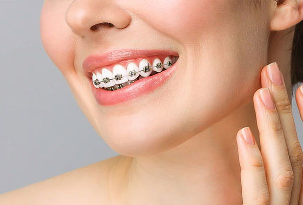 Brackets metálicos mini + Limpieza con ultrasonido y más