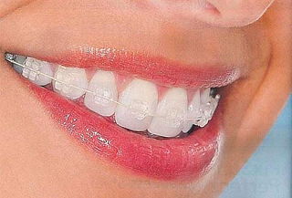 Colocación de Brackets de Zafiro en todos los dientes.