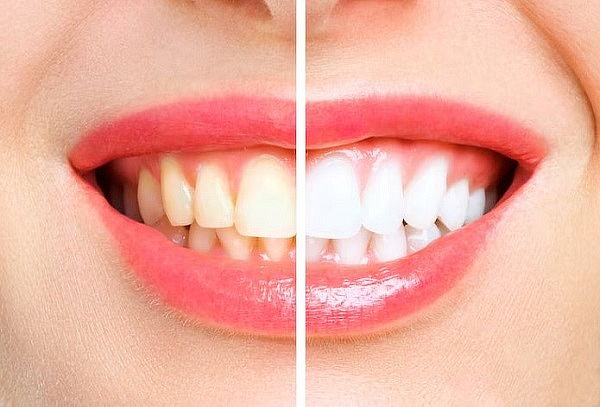 3 Resinas + Limpieza Dental con Ultrasonido + Valoración
