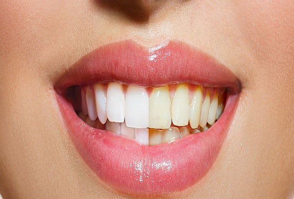 3 Resinas + Limpieza Dental con Ultrasonido + Valoración