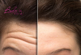 Botox + Limpieza facial + Bebida de cortesía