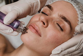 ¡Rejuvenece tu Rostro! 1 o 2 Sesiones de Microneedling  