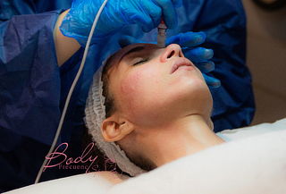 Limpieza Facial profunda con microdermoabrasión con puntas