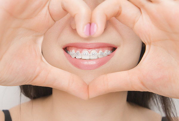 Colocación de Brackets Metálicos + Limpieza