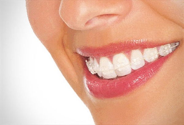 Brackets Metalicos + Limpieza y mas