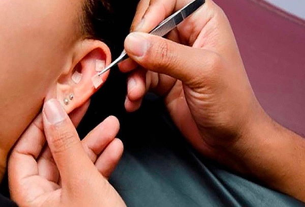 Adelgaza con Auriculoterapia + Plan de Reducción de Tallas