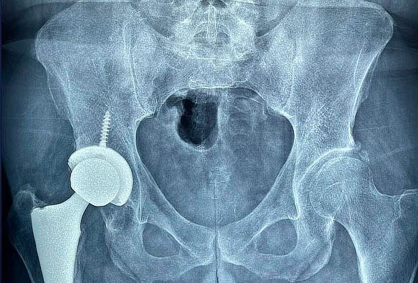 ¡Check Up Ortopédico c/opción a infiltración en H. Ángeles!