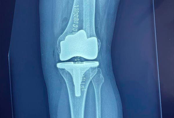 ¡Check Up Ortopédico c/opción a infiltración en H. Ángeles!
